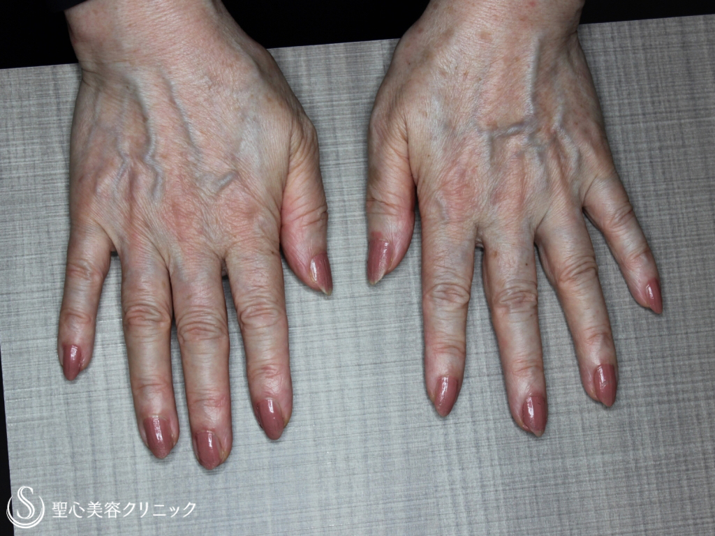 【70代女性・手の甲の若返り】プレミアムPRP皮膚再生療法（1か月後） Before 