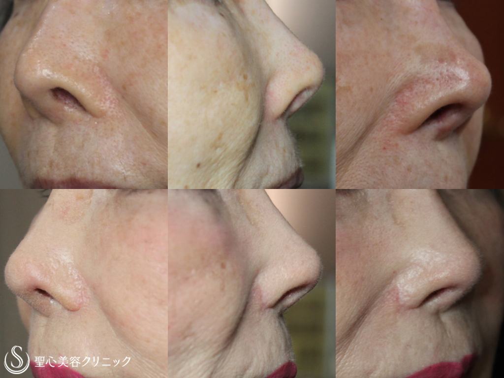 【70代女性・鼻の穴を目立たなく】鼻翼挙上+鼻孔縁下降術（1か月後） After 