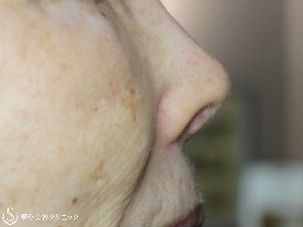 【70代女性・鼻の穴を目立たなく】鼻翼挙上+鼻孔縁下降術（1か月後） Before 