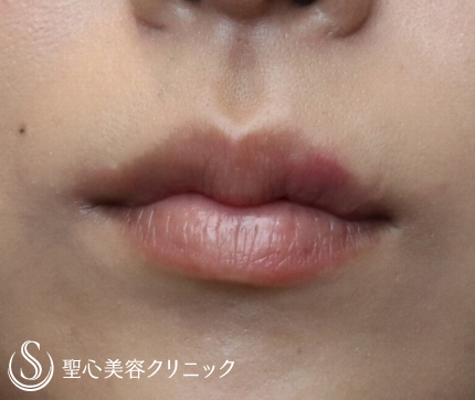 【30代女性・唇を可愛く】M字リップ（1か月後） After 