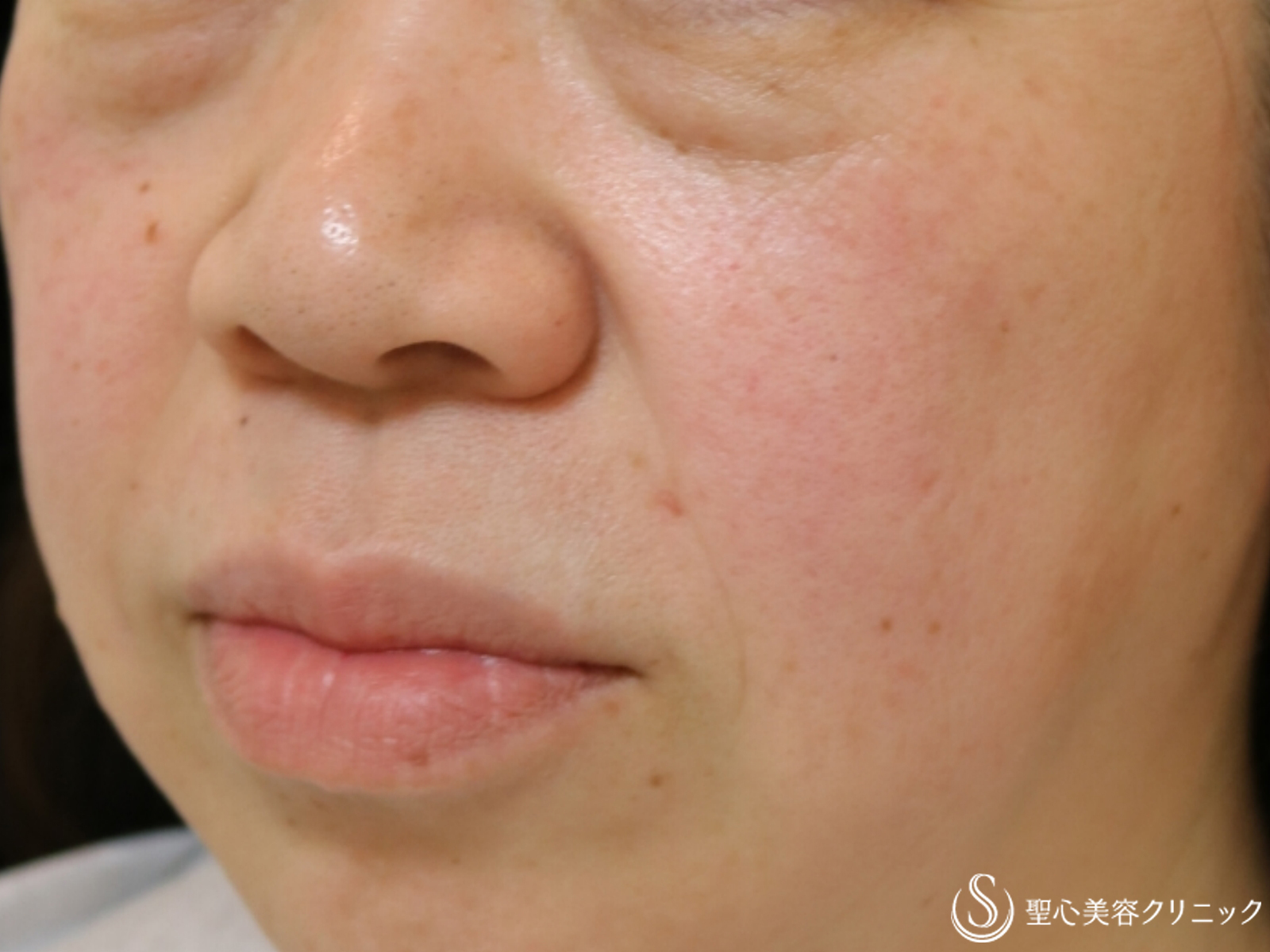 【60代女性・顔のシワ改善】プレミアムPRP皮膚再生療法（10ヶ月後） Before 