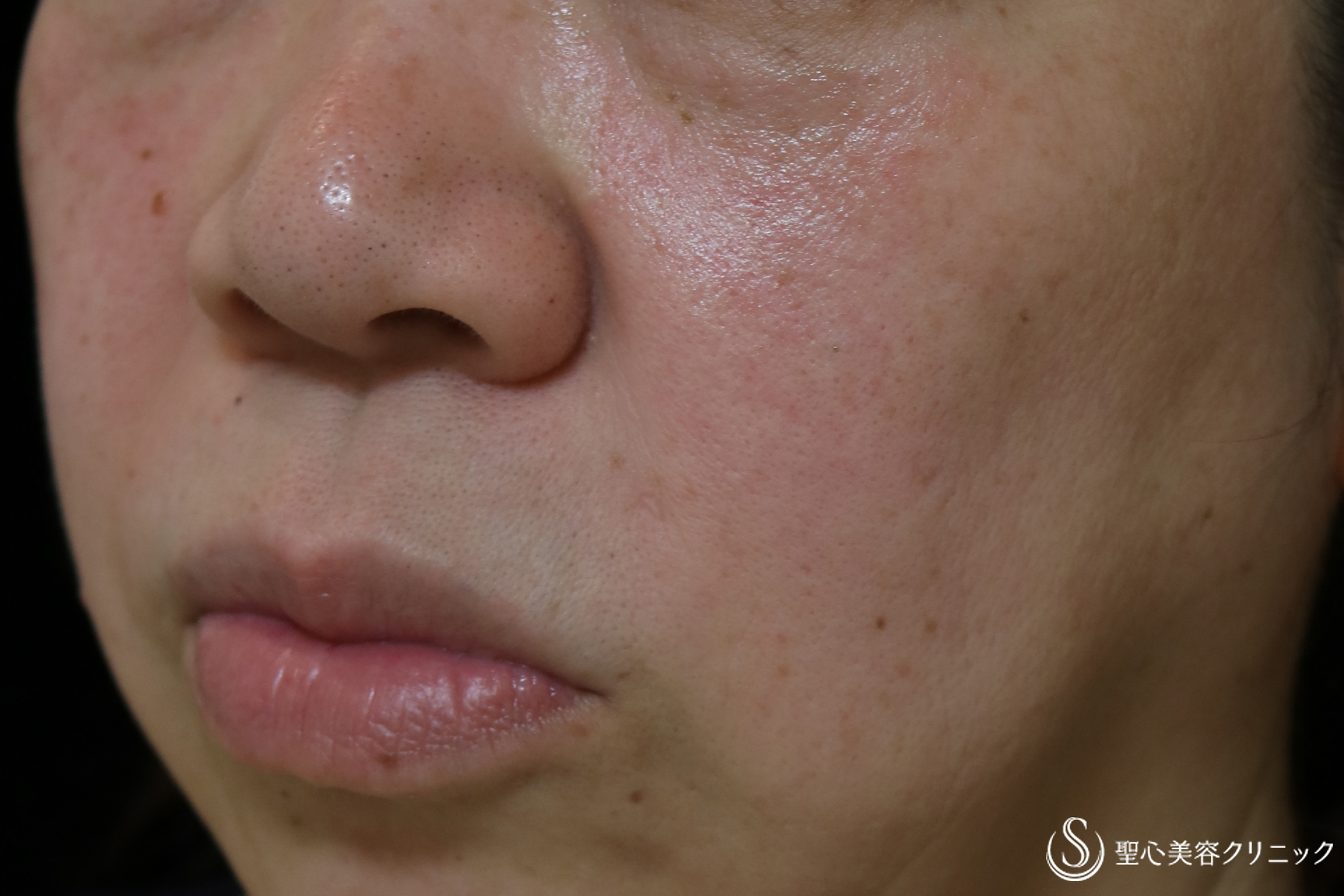 【60代女性・顔のシワ改善】プレミアムPRP皮膚再生療法（10ヶ月後） After 