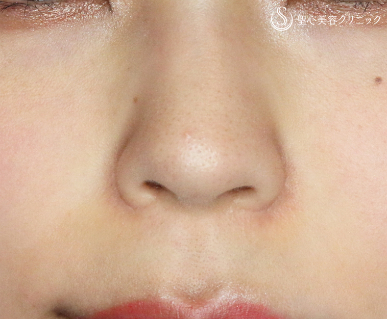 【20代女性・正面から鼻の穴が見える】小鼻縮小術+α法（1年後） After 
