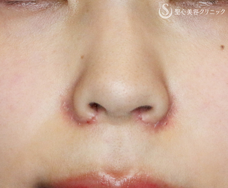 【20代女性・正面から鼻の穴が見える】小鼻縮小術+α法（1年後） After 