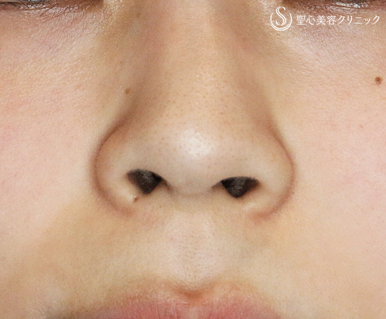 【20代女性・正面から鼻の穴が見える】小鼻縮小術+α法（1年後） Before 