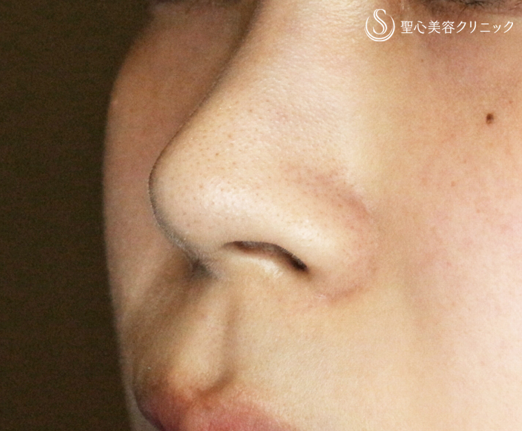 【20代女性・正面から鼻の穴が見える】小鼻縮小術+α法（1年後） Before 