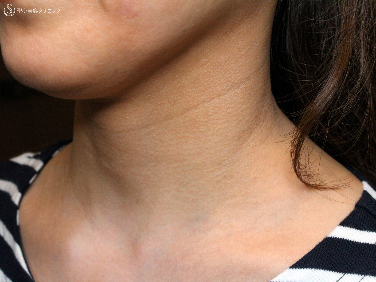 【40代女性・首の横ジワを無かったことに】プレミアムPRP皮膚再生療法（6ヶ月後） Before 