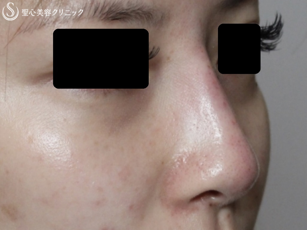 【20代女性・シャープで高い鼻筋に】鼻のヒアルロン酸(クレヴィエル）（注入直後） After 