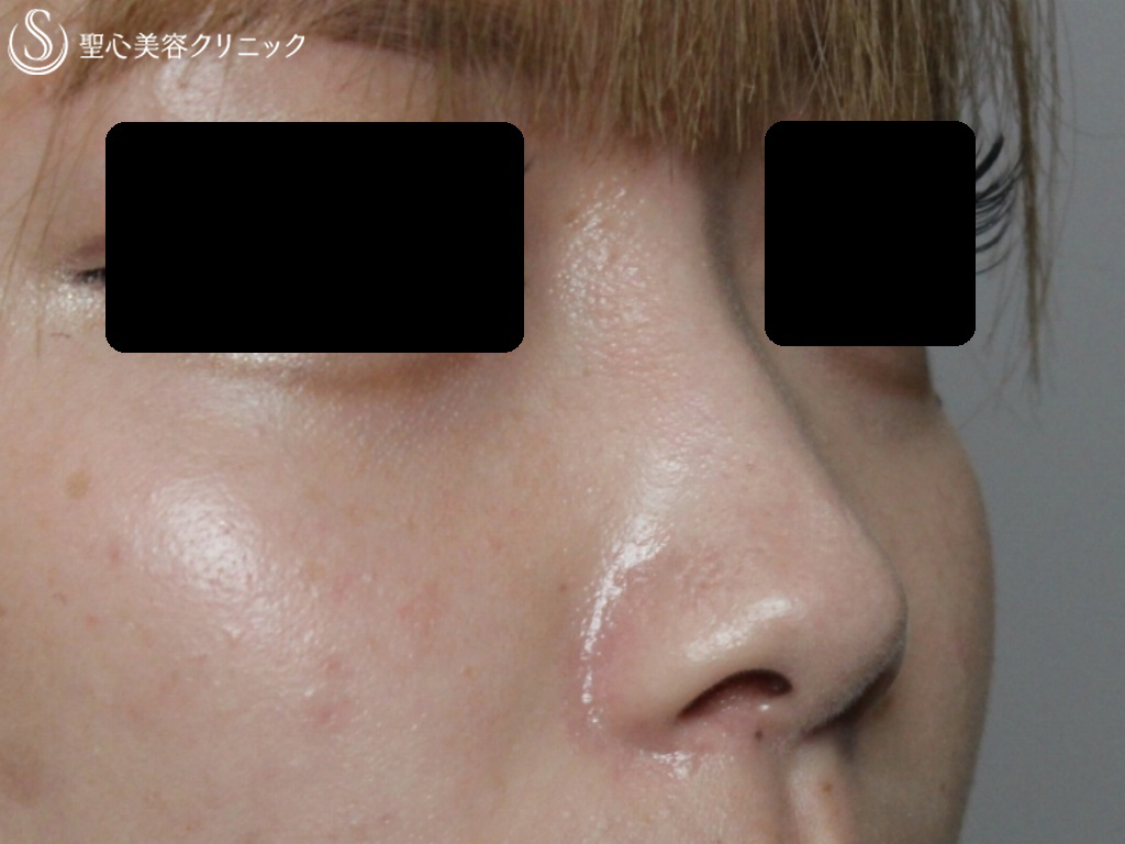 【20代女性・シャープで高い鼻筋に】鼻のヒアルロン酸(クレヴィエル）（注入直後） Before 
