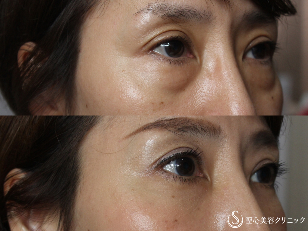 【40代女性・目の下の若返り】経結膜下脱脂法+プレミアムPRP皮膚再生療法（1ヶ月後） After 