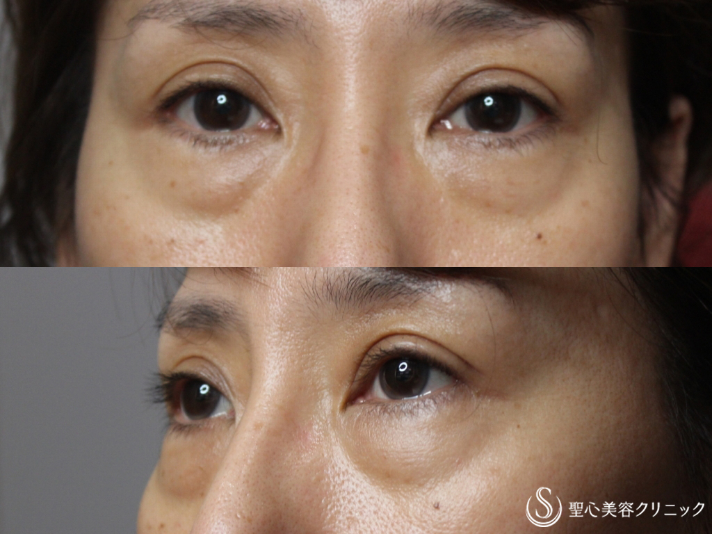 【40代女性・目の下の若返り】経結膜下脱脂法+プレミアムPRP皮膚再生療法（1ヶ月後） Before 