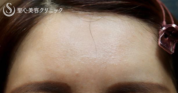 【女性・額を丸く】プレミアムPRP 皮膚再生療法（4年後） After 