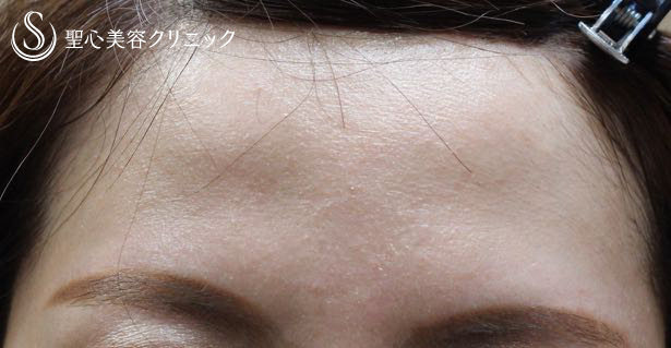 【女性・額を丸く】プレミアムPRP 皮膚再生療法（4年後） Before 