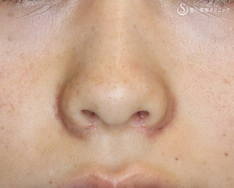 【30代女性・正面から鼻の穴が見える大きな鼻】小鼻縮小術+α法（4ヶ月後） After 
