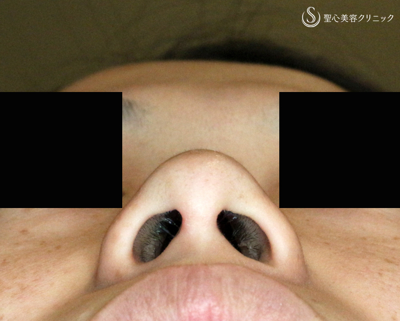 【30代女性・正面から鼻の穴が見える大きな鼻】小鼻縮小術+α法（4ヶ月後） Before 