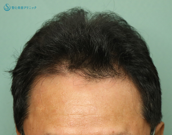 【50代男性・薄毛治療でハリコシも改善】ミノキシジルタブレット+ビビスカル プロ（3ヶ月後と6ヶ月後） Before 