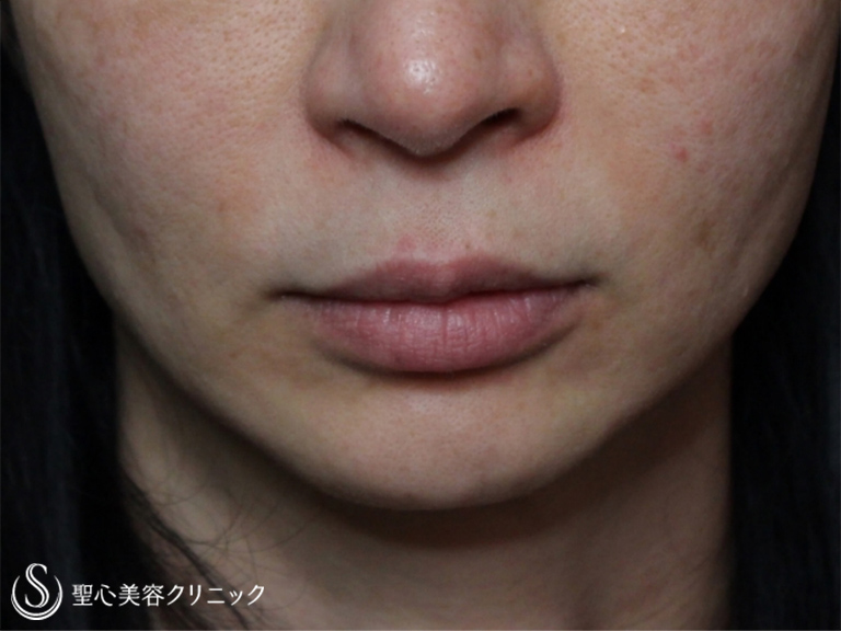 【40代女性・頬をふっくらと】プレミアムPRP皮膚再生療法（処置後2年） After 