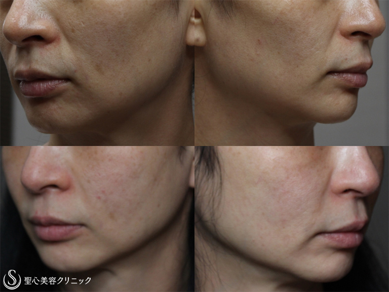 【40代女性・頬をふっくらと】プレミアムPRP皮膚再生療法（処置後2年） After 