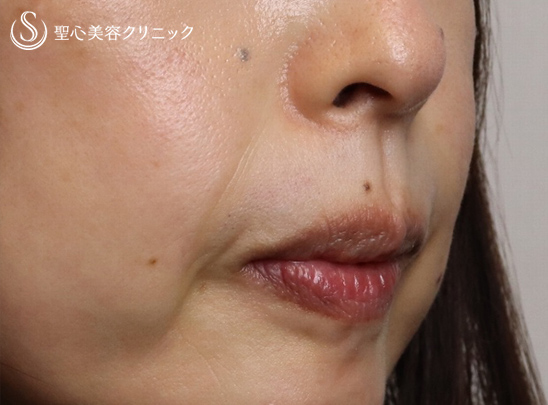 【40代女性・ほうれい線】プレミアムPRP皮膚再生療法（4ヶ月・6ヶ月） After 