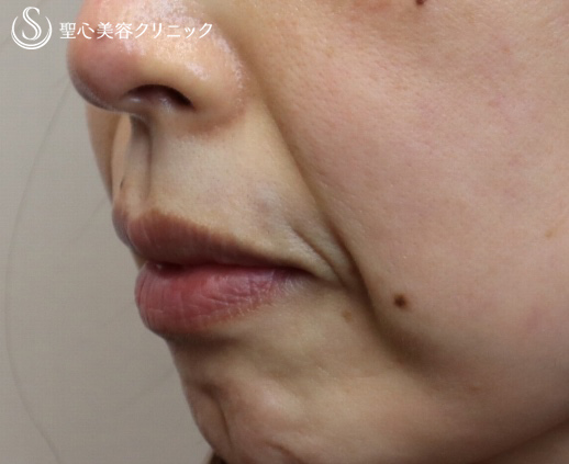 【40代女性・ほうれい線】プレミアムPRP皮膚再生療法（4ヶ月・6ヶ月） Before 