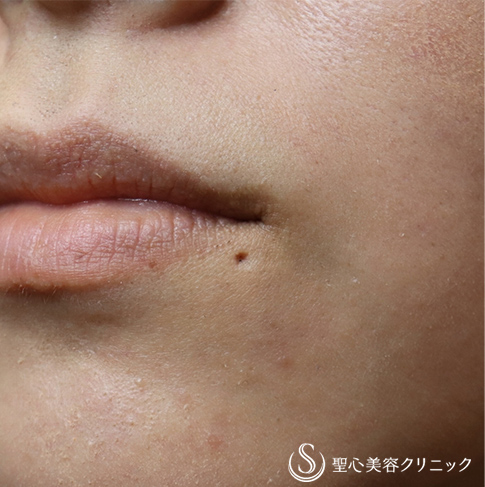 30代女性 ピアスの穴跡も綺麗に ピアス穴閉じ修正 7ヶ月後 症例写真 美容整形 美容外科なら聖心美容クリニック 30代女性 ピアスの穴跡も綺麗に ピアス穴閉じ修正 7ヶ月後 症例写真 美容整形 美容外科なら聖心美容クリニック