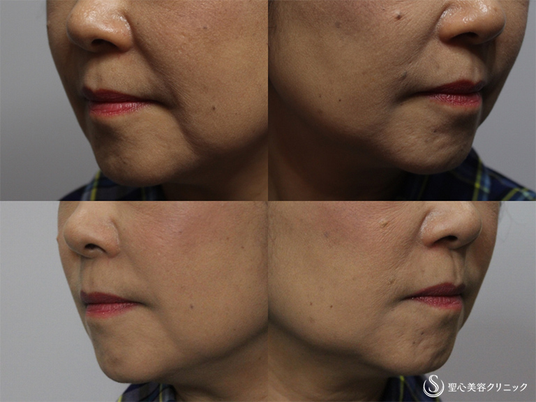 【60代女性・法令線を改善】プレミアムPRP皮膚再生療法（1ヶ月後） After 