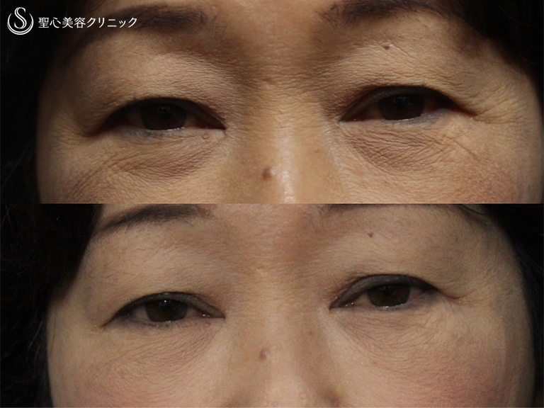 【60代女性・目の下をきれいに】目の下のプレミアムPRP（1ヶ月後） After 
