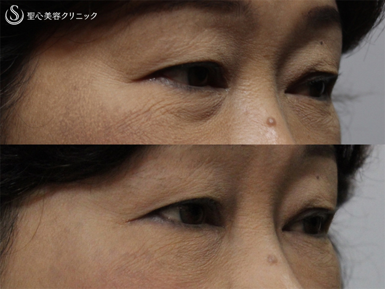 【60代女性・目の下をきれいに】目の下のプレミアムPRP（1ヶ月後） After 