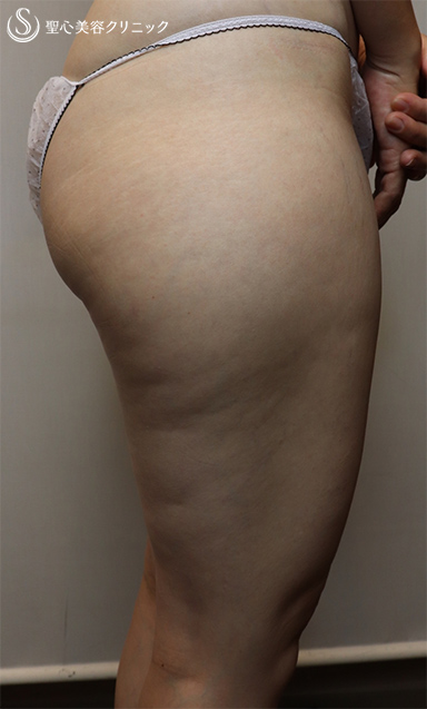 【40代女性・足痩せのための脂肪吸引】ベイザー脂肪吸引（1ヶ月後） Before 