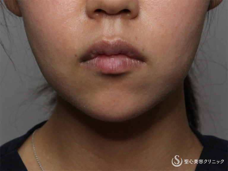 【30代女性・頬のふくらみが気になる】新しい頬の脂肪溶解注射：チンセラ（1ヶ月後） After 
