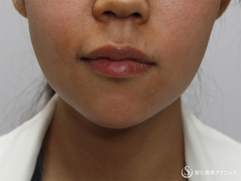 【30代女性・頬のふくらみが気になる】新しい頬の脂肪溶解注射：チンセラ（1ヶ月後） Before 