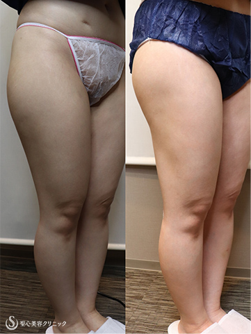 【20代女性・下半身痩せの脂肪吸引】ベイザー脂肪吸引（３ヶ月後） After 