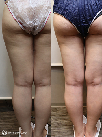 【20代女性・下半身痩せの脂肪吸引】ベイザー脂肪吸引（３ヶ月後） After 