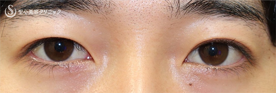 30代男性 目元でお顔の印象が変わります 二重全切開 1ヶ月後 症例写真 美容整形 美容外科なら聖心美容クリニック