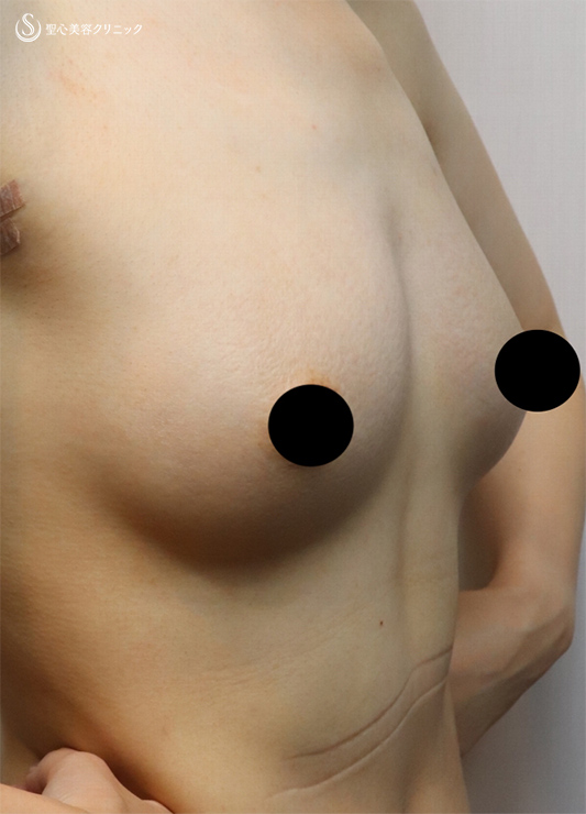 【20代女性・胸大きく、足細く】ピュアグラフト豊胸術（１ヶ月後） After 