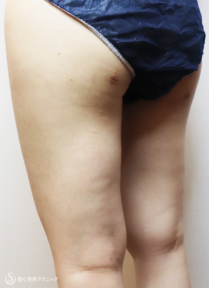 【20代女性・胸大きく、足細く】ピュアグラフト豊胸術（１ヶ月後） After 
