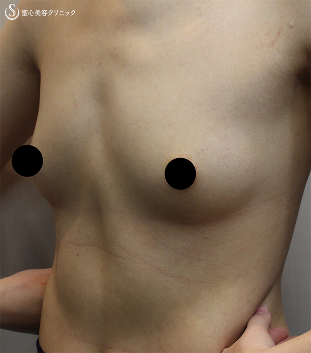 【20代女性・胸大きく、足細く】ピュアグラフト豊胸術（１ヶ月後） Before 