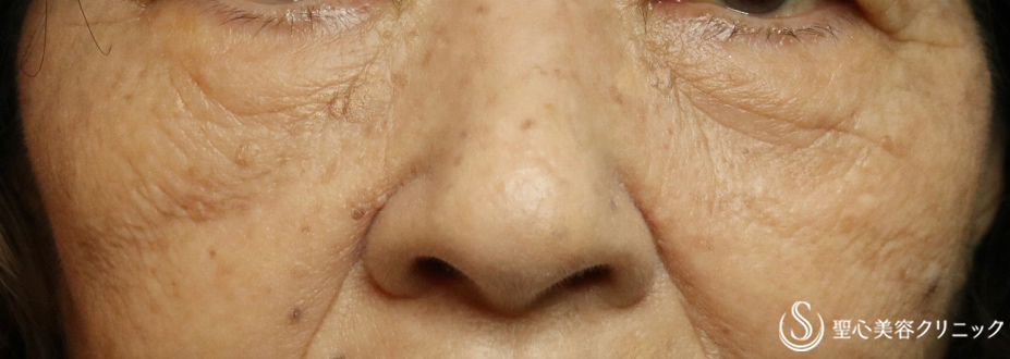 【70代女性・目の下のたるみ】プレミアムPRP皮膚再生療法（３ヶ月後） After 