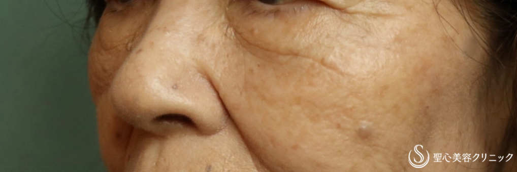 【70代女性・目の下のたるみ】プレミアムPRP皮膚再生療法（３ヶ月後） After 