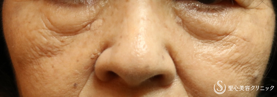 【70代女性・目の下のたるみ】プレミアムPRP皮膚再生療法（３ヶ月後） Before 