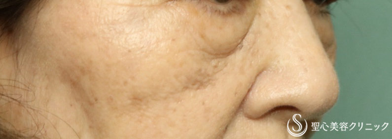 【70代女性・目の下のたるみ】プレミアムPRP皮膚再生療法（３ヶ月後） Before 