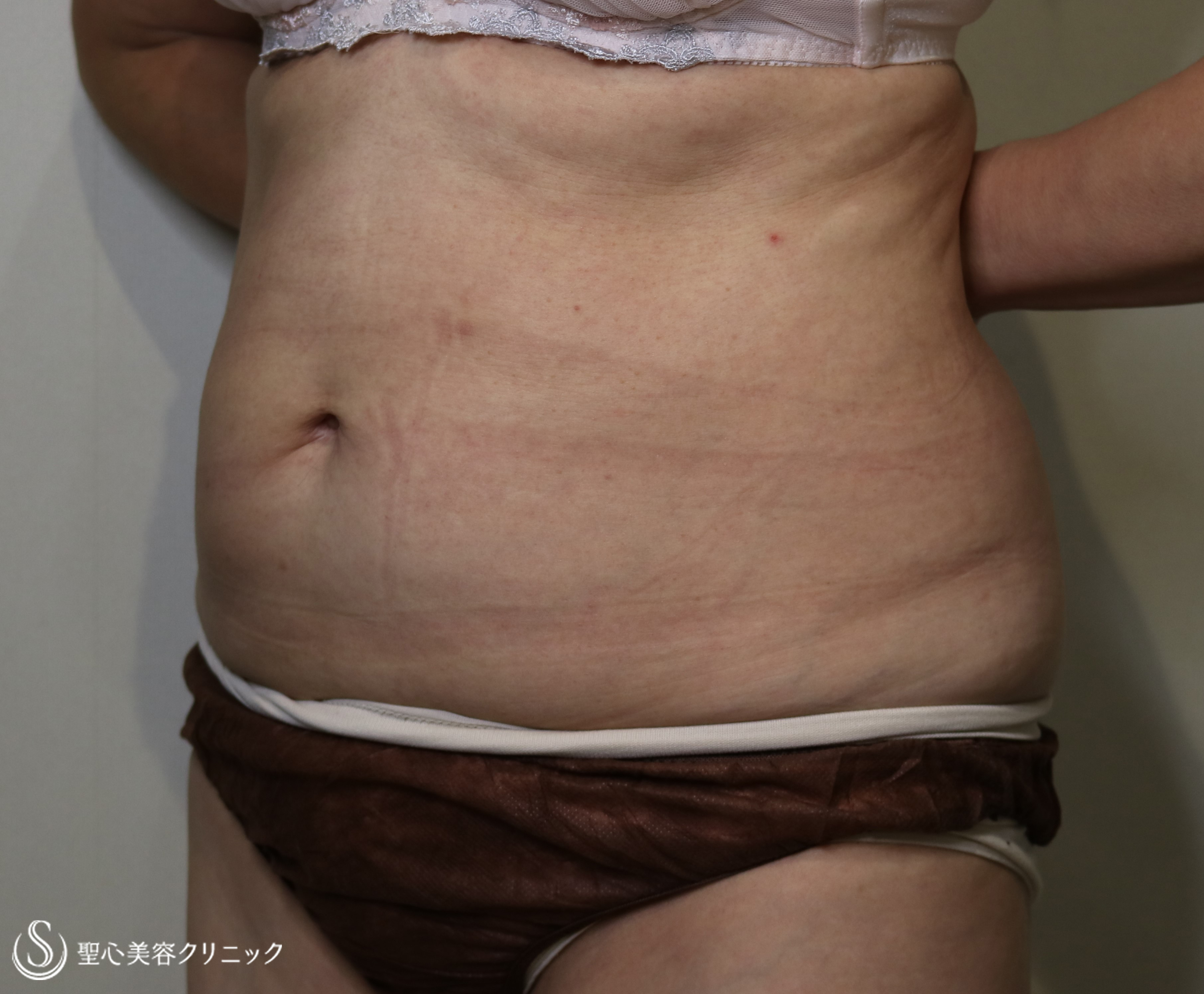 【60代女性・腹部痩身】リポセル（3ヶ月後） After 