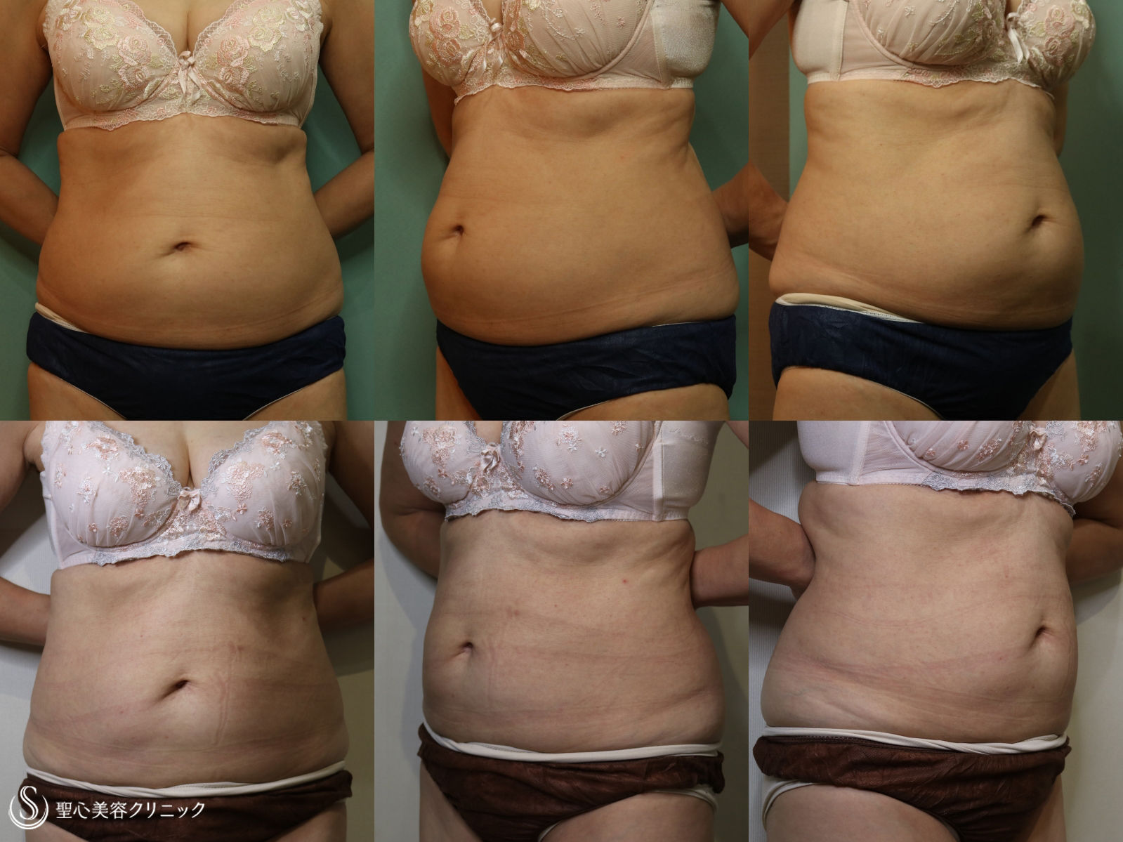 【60代女性・腹部痩身】リポセル（3ヶ月後） After 