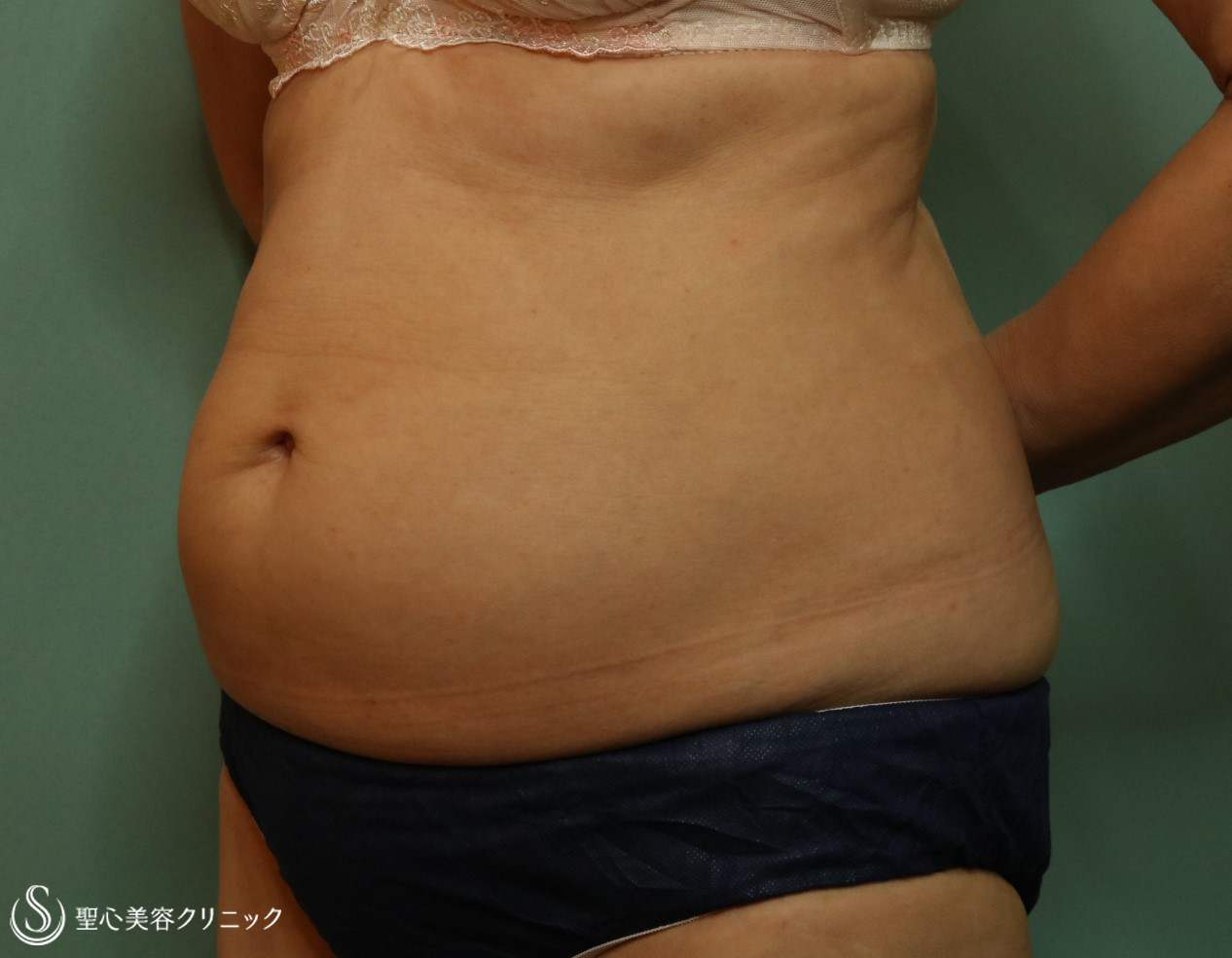 【60代女性・腹部痩身】リポセル（3ヶ月後） Before 