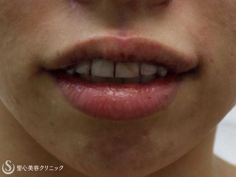 【20代女性・キュートな唇に】プレミアム口角挙上+キュート（M字）リップ（１週間後） Before 