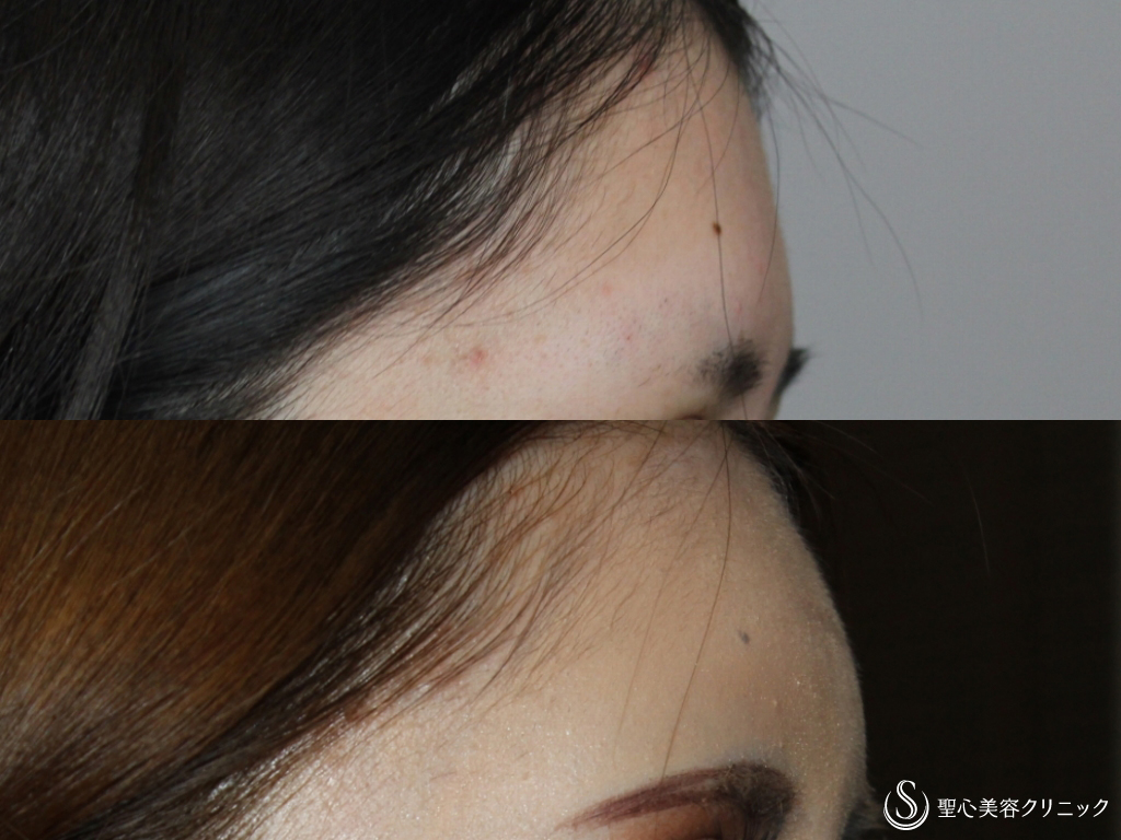 【20代女性・ふっくらと綺麗な輪郭に】額のプレミアムPRP皮膚再生療法（1ヶ月後） After 