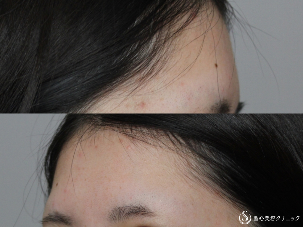 【20代女性・ふっくらと綺麗な輪郭に】額のプレミアムPRP皮膚再生療法（1ヶ月後） Before 