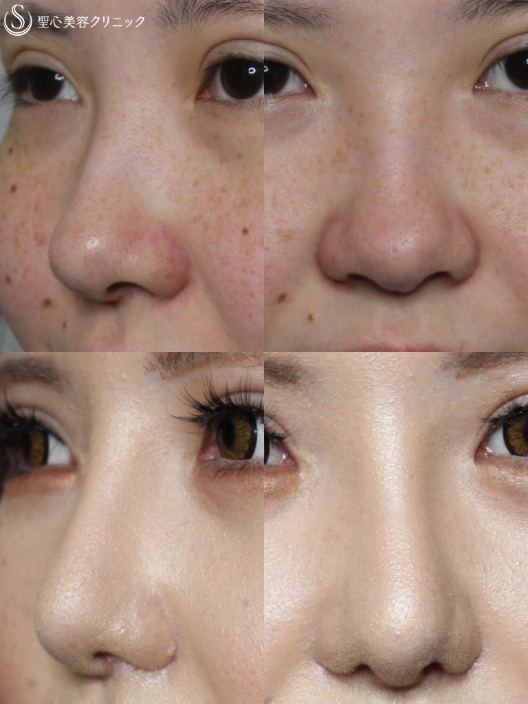【20代女性・理想の鼻に】鼻の複合手術（プロテーゼ、鼻尖縮小、鼻翼軟骨移植、小鼻縮小）（１ヶ月後） After 
