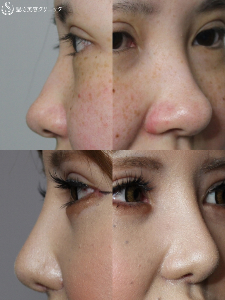 【20代女性・理想の鼻に】鼻の複合手術（プロテーゼ、鼻尖縮小、鼻翼軟骨移植、小鼻縮小）（１ヶ月後） After 