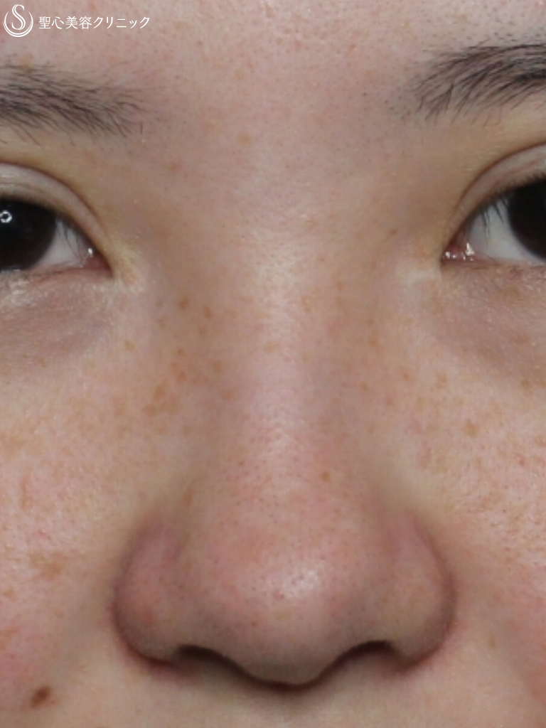 【20代女性・理想の鼻に】鼻の複合手術（プロテーゼ、鼻尖縮小、鼻翼軟骨移植、小鼻縮小）（１ヶ月後） Before 